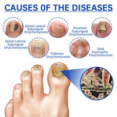 Fungus Laser Therapy Device